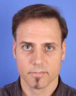 After Hair Transplant &nbsp;Revision